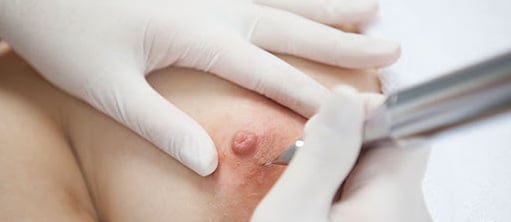 pigmentacja-medyczna-estetica